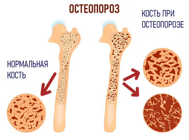 Мягкая ткань костей